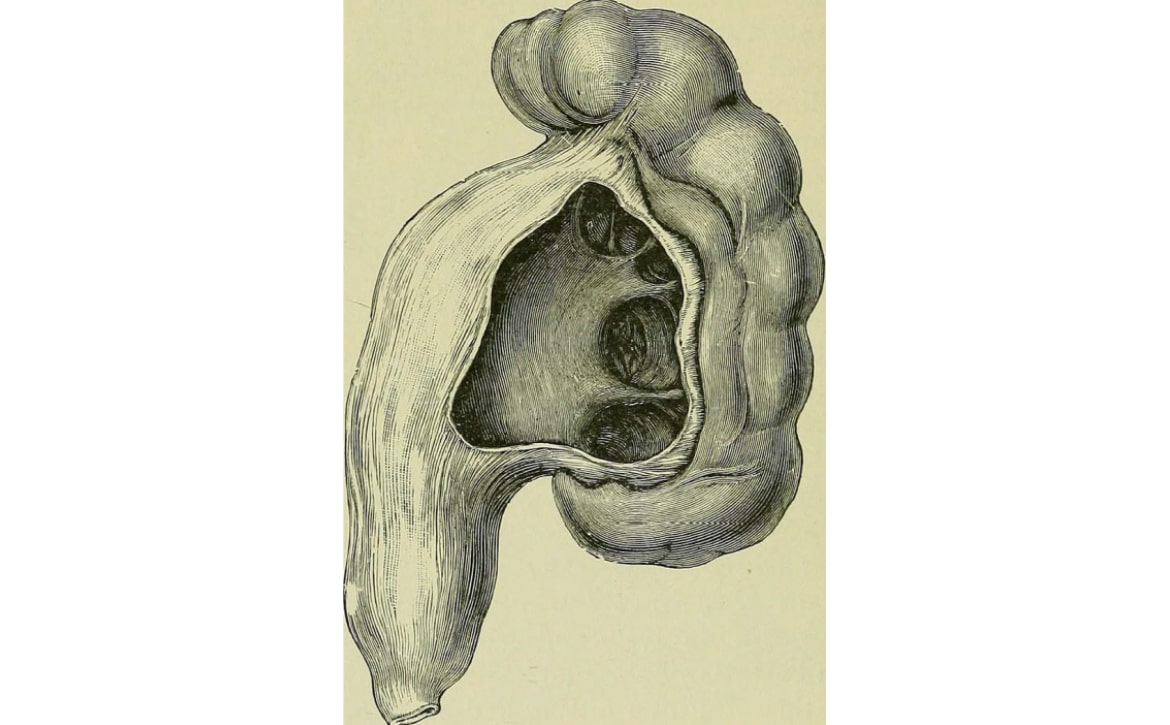 Hydronéphrose prénatale
